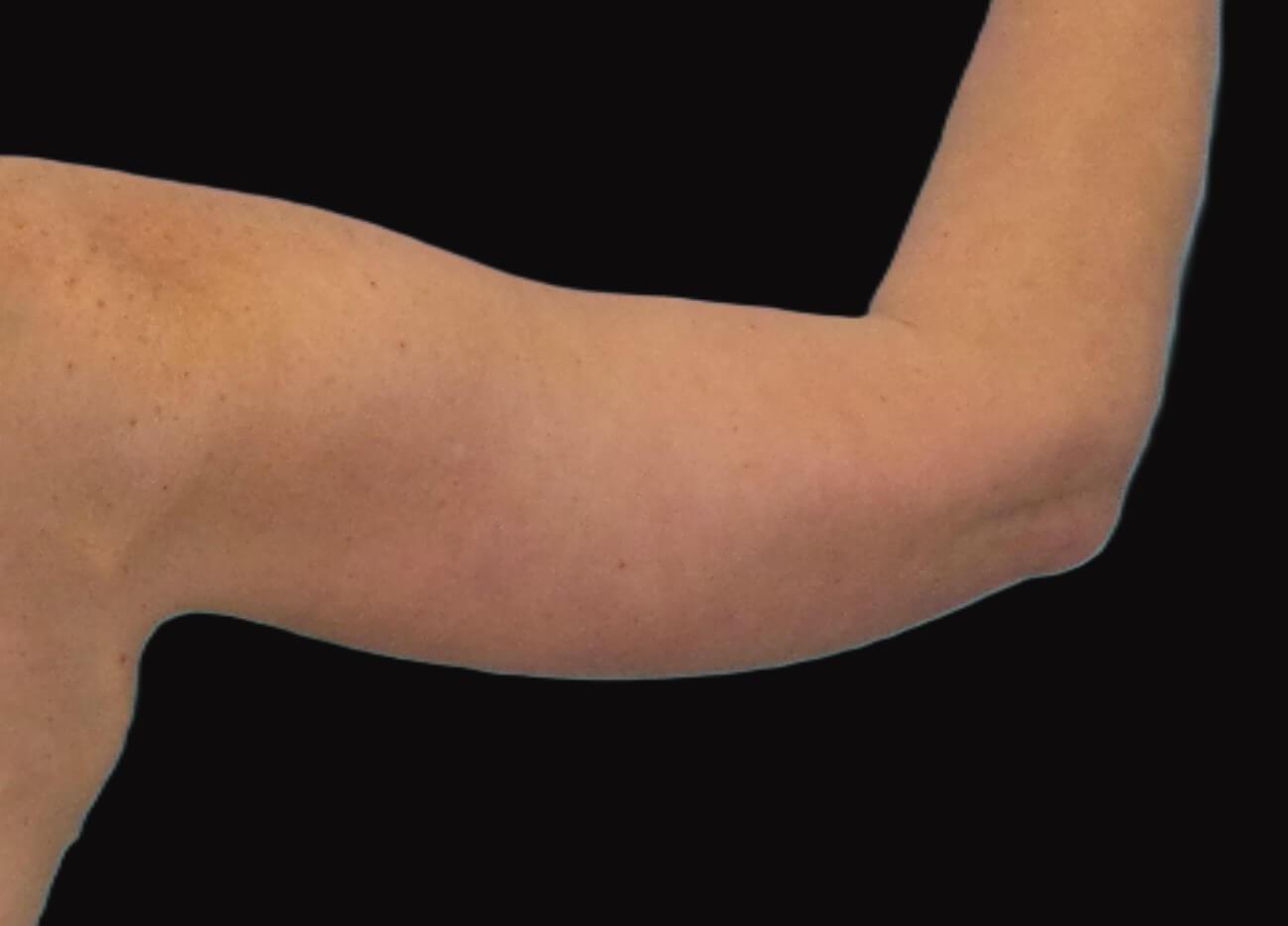 Sean Simon, MD arm lift after — Miami, FL