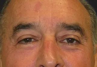 Sean Simon, MD eyelid lift after — Miami, FL