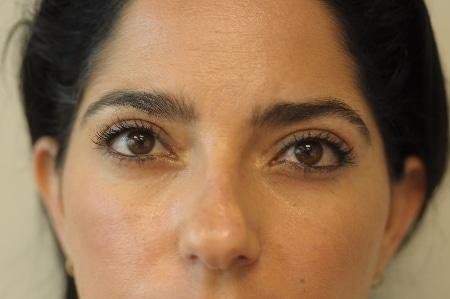 Looking Good (Houston) blepharoplasty after — Houston, TX