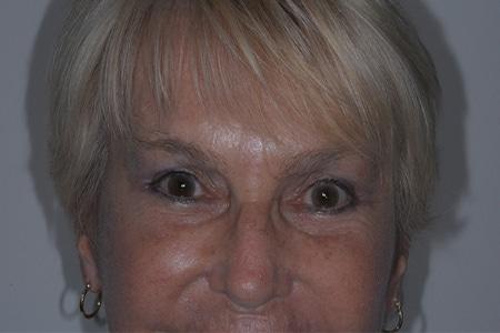 Looking Good (Houston) blepharoplasty after — Houston, TX