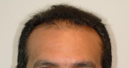 Looking Good (Houston) hair restoration result — Houston, TX