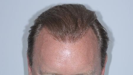 Looking Good (Houston) hair restoration result — Houston, TX
