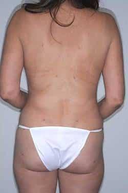 Looking Good (Houston) liposuction after — Houston, TX