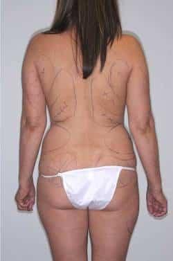 Liposuction before at Looking Good (Houston) in Houston, TX