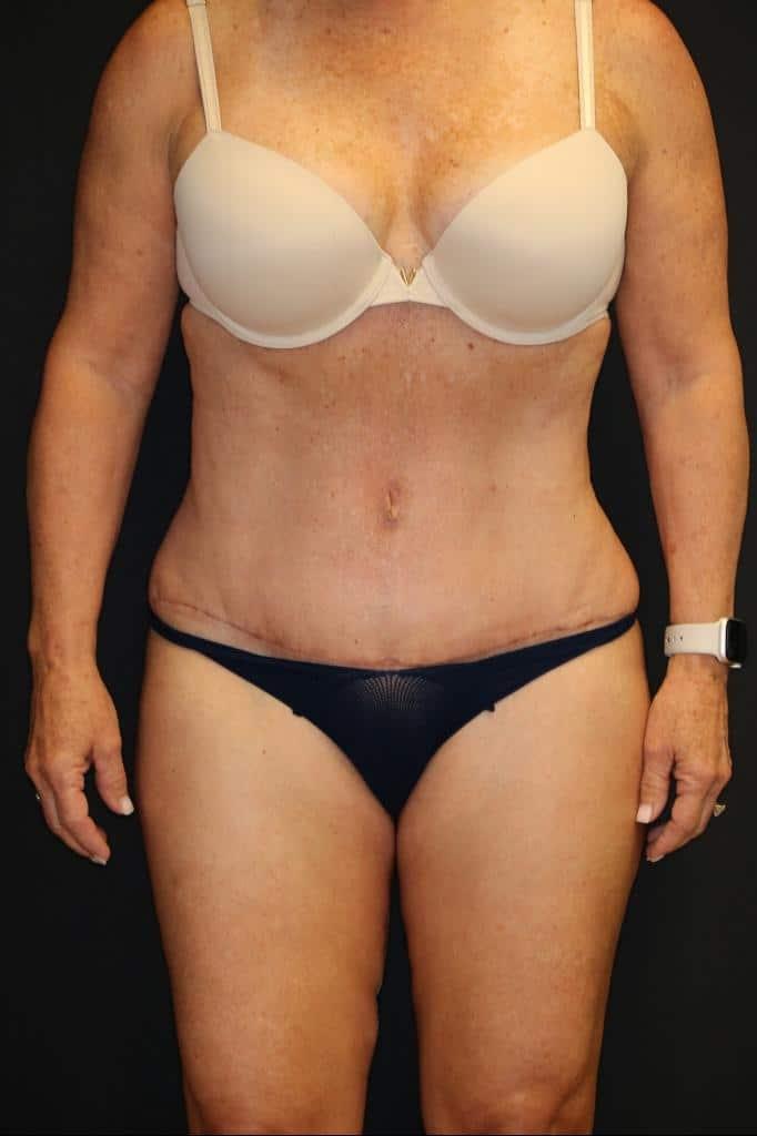 Looking Good (Houston) tummy tuck after — Houston, TX