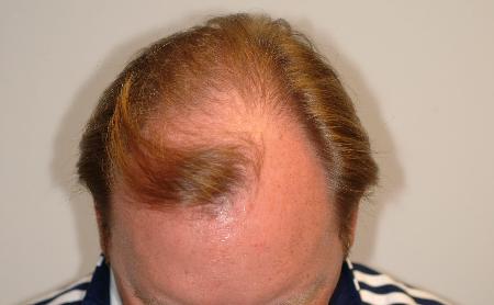 Looking Good (Houston) hair restoration result — Houston, TX