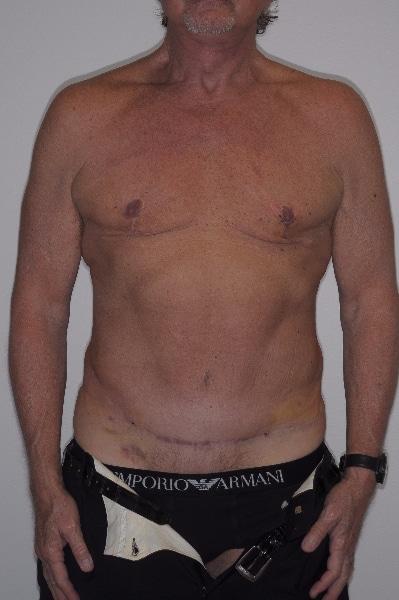 Gynecomastia Surgery after at Looking Good (Houston) in Houston, TX