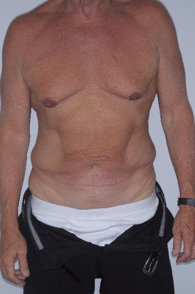 Gynecomastia Surgery before at Looking Good (Houston) in Houston, TX