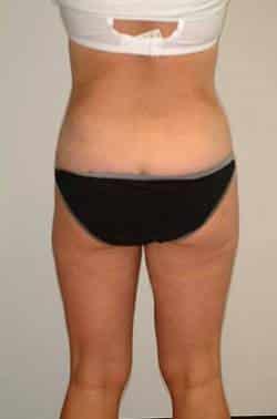 Looking Good (Houston) liposuction after — Houston, TX