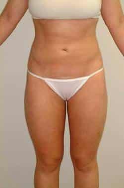 Looking Good (Houston) liposuction after — Houston, TX