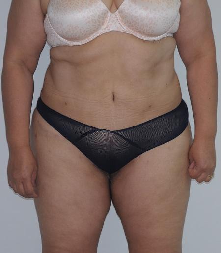 Looking Good (Houston) tummy tuck after — Houston, TX