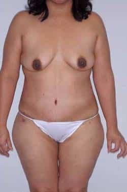 Looking Good (Houston) tummy tuck after — Houston, TX