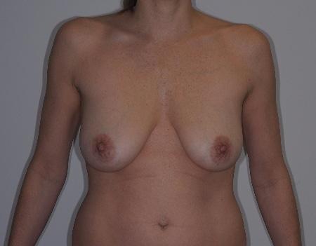 Breast Lift before at Looking Good (Houston) in Houston, TX