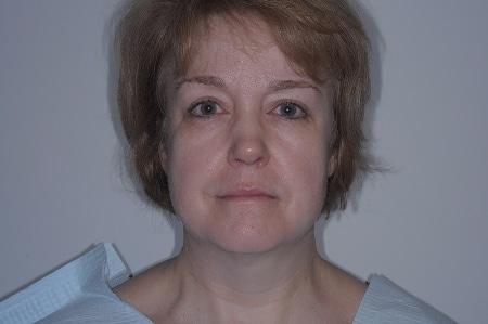 Facelift before at Looking Good (Houston) in Houston, TX