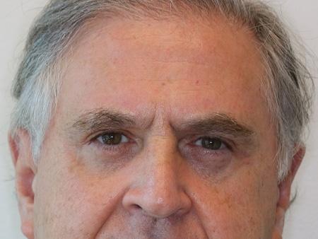Looking Good (Houston) blepharoplasty after — Houston, TX
