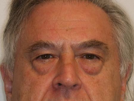Blepharoplasty before at Looking Good (Houston) in Houston, TX