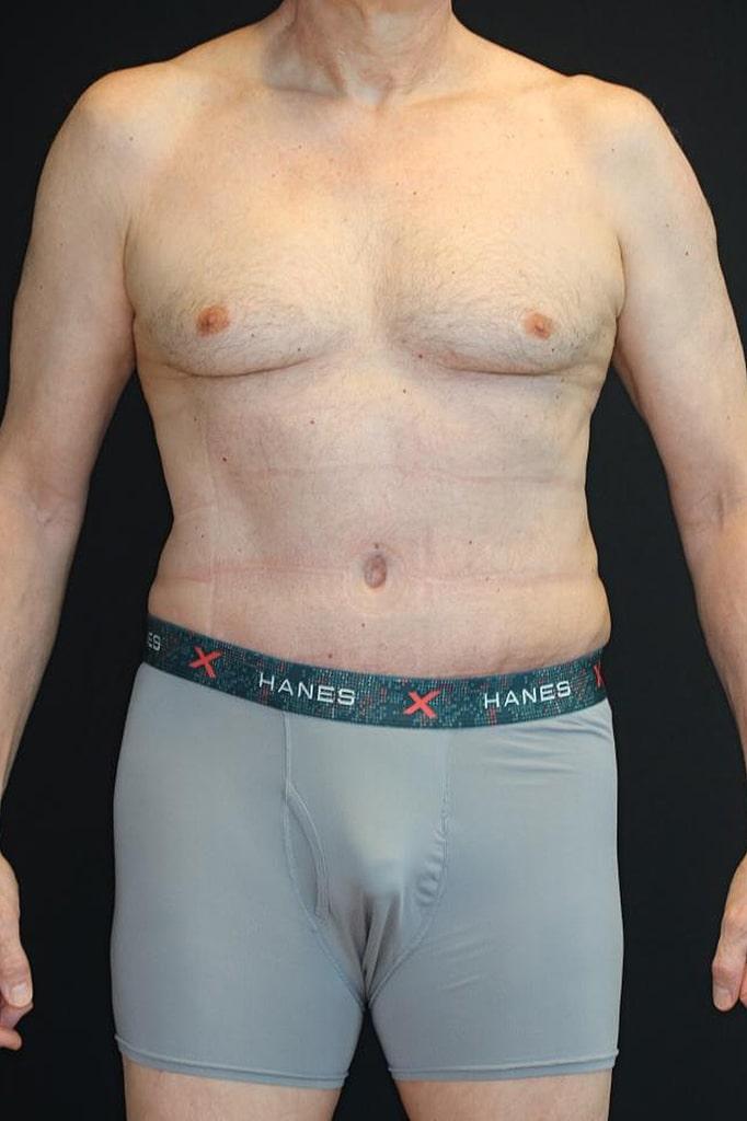 Looking Good (Houston) tummy tuck after — Houston, TX