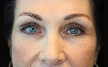 Looking Good (Houston) blepharoplasty after — Houston, TX