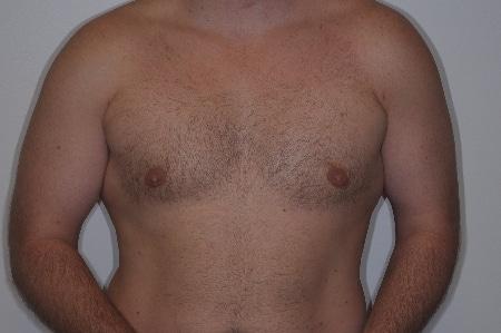 Looking Good (Houston) gynecomastia after — Houston, TX