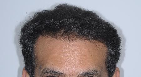Looking Good (Houston) hair restoration result — Houston, TX