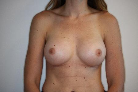 Looking Good (Houston) breast augmentation after — Houston, TX