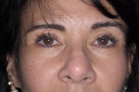 Looking Good (Houston) blepharoplasty after — Houston, TX