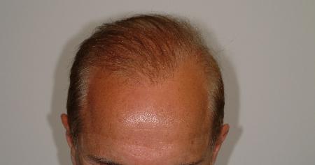 Looking Good (Houston) hair restoration result — Houston, TX