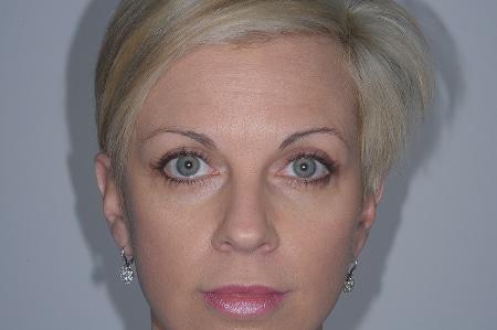 Looking Good (Houston) blepharoplasty after — Houston, TX