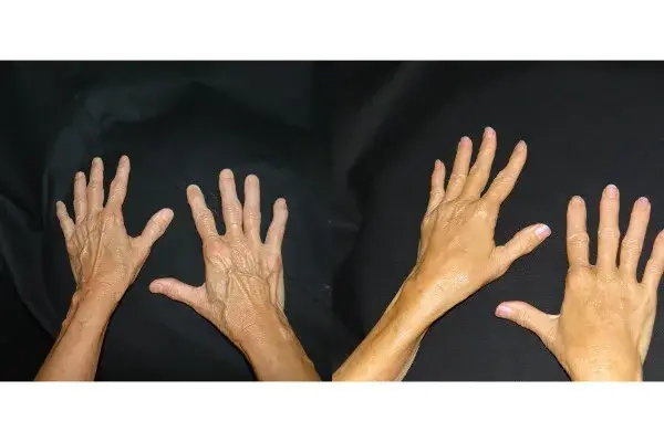 Fat Transfer result at Associates in Plastic Surgery in Virginia Beach, VA