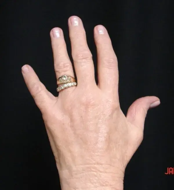 Fat Transfer after at Associates in Plastic Surgery in Virginia Beach, VA