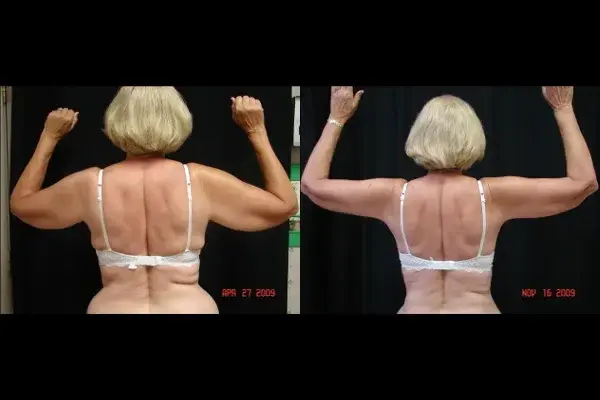 Arm Lift result at Associates in Plastic Surgery in Virginia Beach, VA