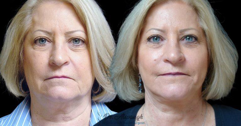 Associates in Plastic Surgery result — Virginia Beach, VA