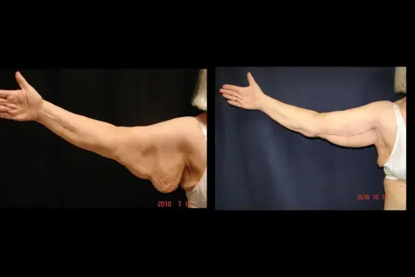 Arm Lift result at Associates in Plastic Surgery in Virginia Beach, VA
