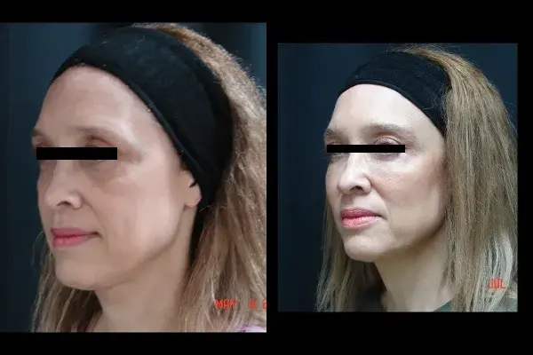 Juvederm result at Associates in Plastic Surgery in Virginia Beach, VA