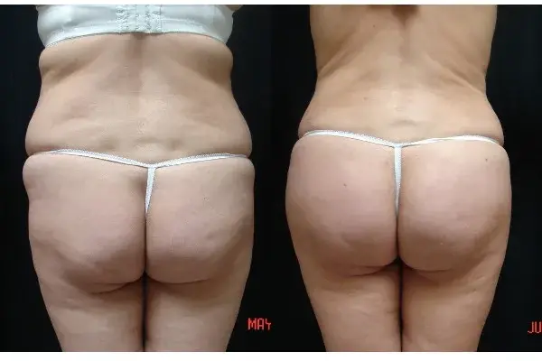 Associates in Plastic Surgery bbl result — Virginia Beach, VA