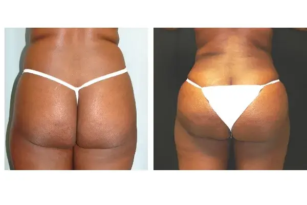 Associates in Plastic Surgery bbl result — Virginia Beach, VA