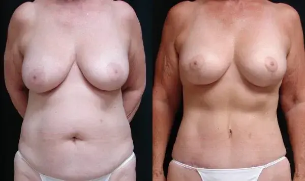 Mommy Makeover result at Associates in Plastic Surgery in Virginia Beach, VA