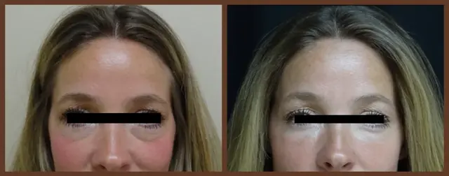 Juvederm result at Associates in Plastic Surgery in Virginia Beach, VA