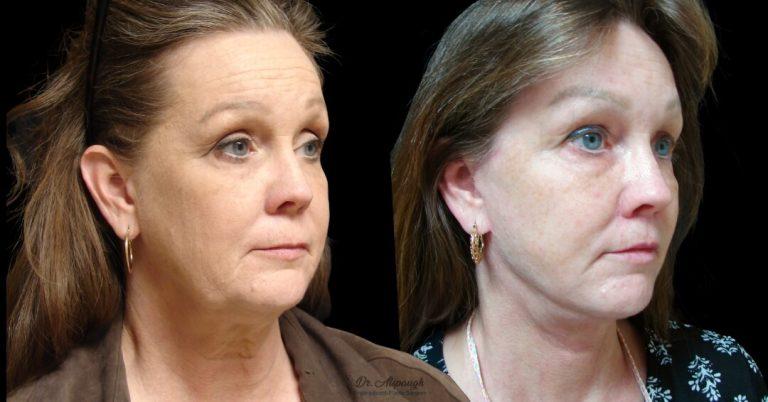 Associates in Plastic Surgery result — Virginia Beach, VA