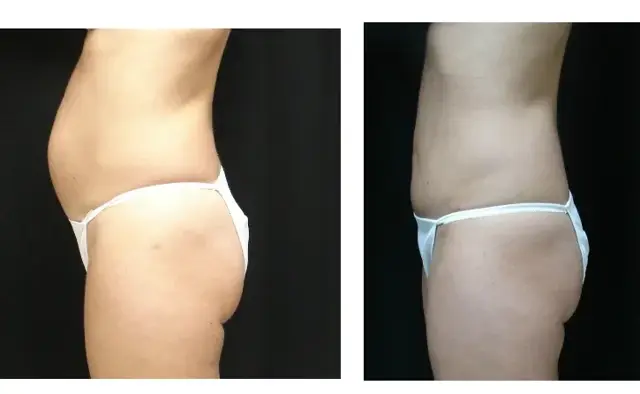 Mini Tummy Tuck result at Associates in Plastic Surgery in Virginia Beach, VA