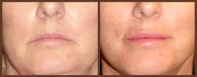 Juvederm result at Associates in Plastic Surgery in Virginia Beach, VA