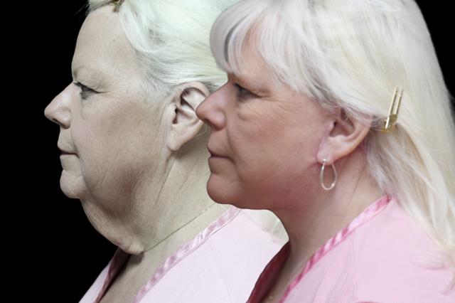 Neck Lift result at Associates in Plastic Surgery in Virginia Beach, VA
