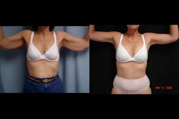 Arm Lift result at Associates in Plastic Surgery in Virginia Beach, VA