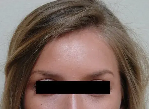 Botox after at Associates in Plastic Surgery in Virginia Beach, VA