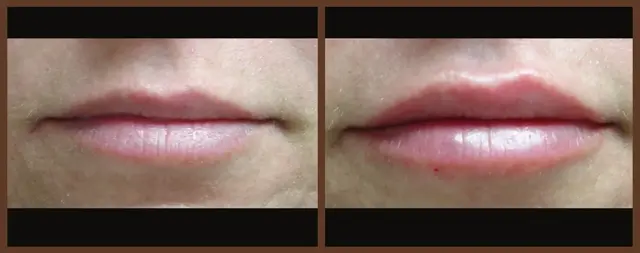 Juvederm result at Associates in Plastic Surgery in Virginia Beach, VA