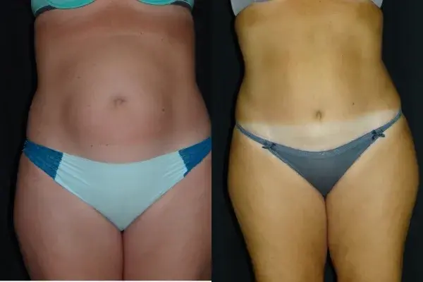 Mini Tummy Tuck result at Associates in Plastic Surgery in Virginia Beach, VA
