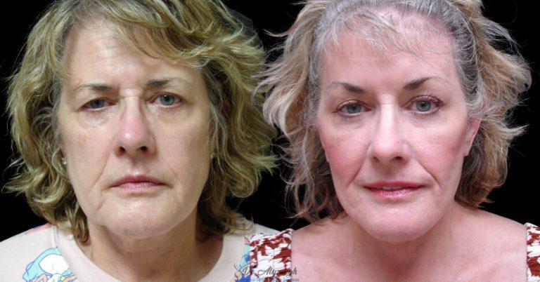 Associates in Plastic Surgery result — Virginia Beach, VA