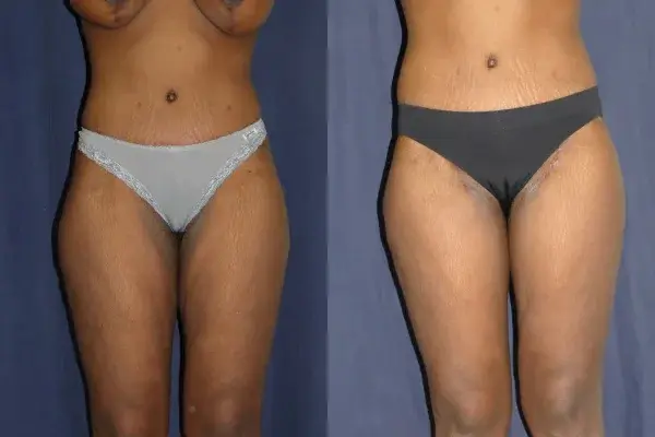 Associates in Plastic Surgery thigh lift result — Virginia Beach, VA