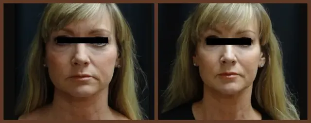 Juvederm result at Associates in Plastic Surgery in Virginia Beach, VA