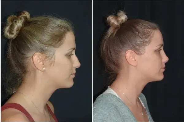 Functional Rhinoplasty result at Associates in Plastic Surgery in Virginia Beach, VA